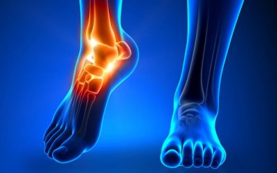 Спортивный травматизм